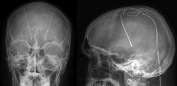 脑深部刺激的 MRI