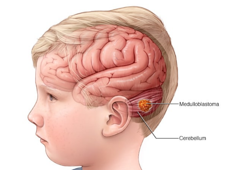 髓母细胞瘤