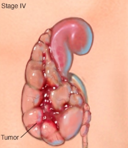 四期肾肿瘤