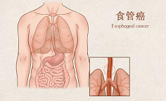 美国克利夫兰医学中心权威专家解读：2023 ASCO大会“食管癌”重磅研究成果