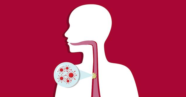 食管癌的早期症状有哪些？食管癌病因是什么？