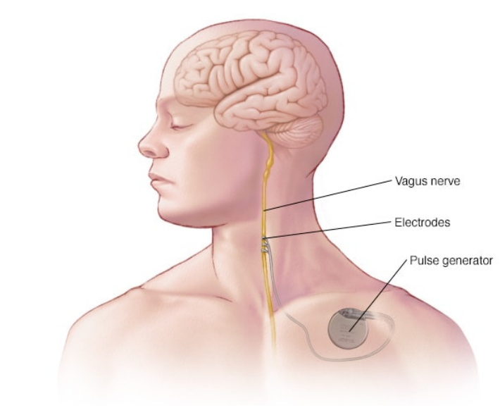 迷走神经电刺激