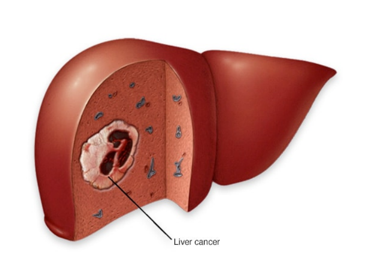 肝癌