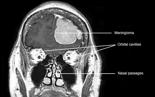 脑膜瘤影像