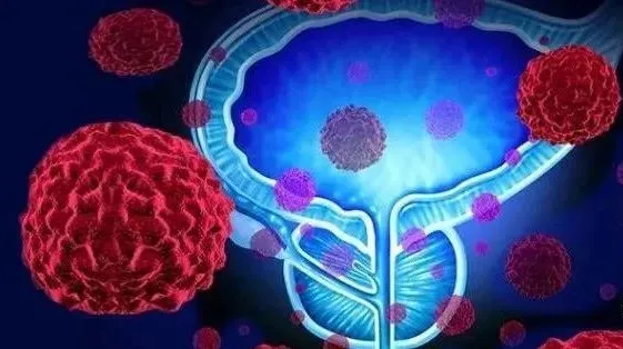 前列腺癌如何诊断确诊？如何治疗前列腺癌？