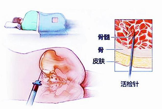 骨髓检查