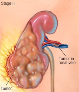III 期肾肿瘤