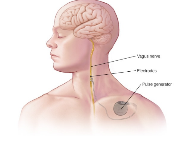 迷走神经电刺激