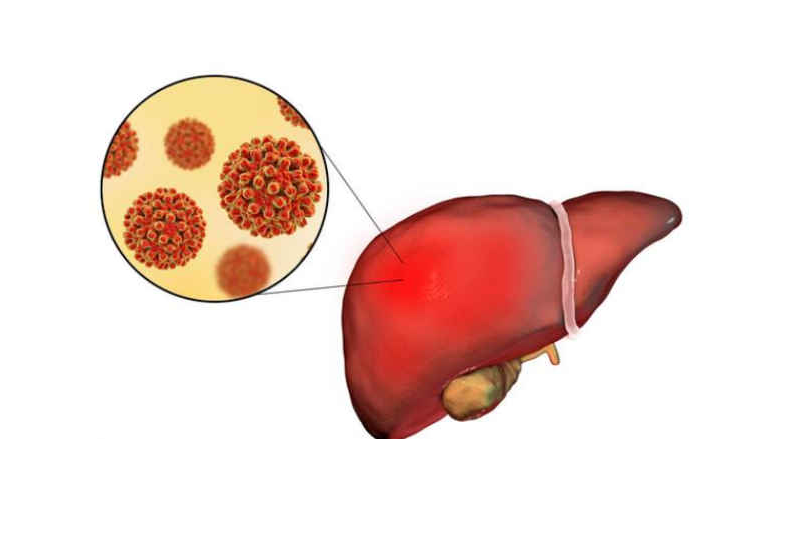 肝细胞癌