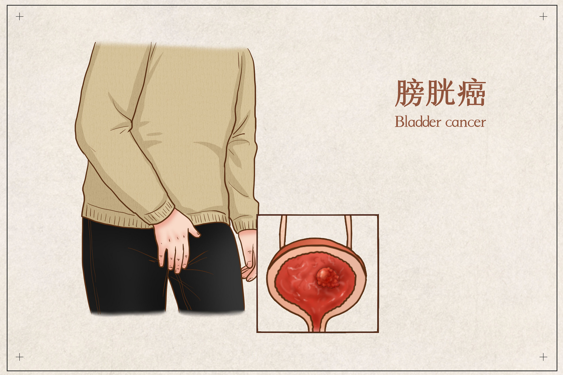 膀胱癌日本手术的优势与就医指南