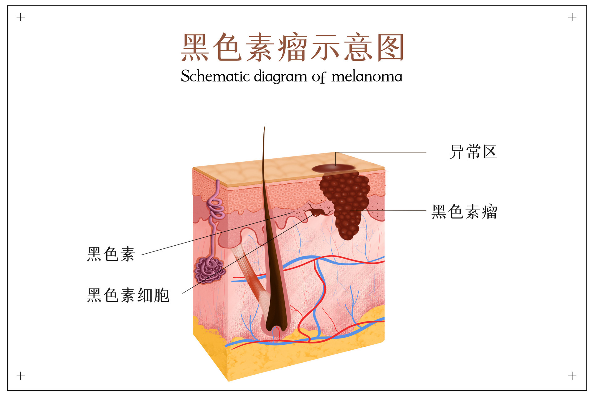 美国治疗黑色素瘤