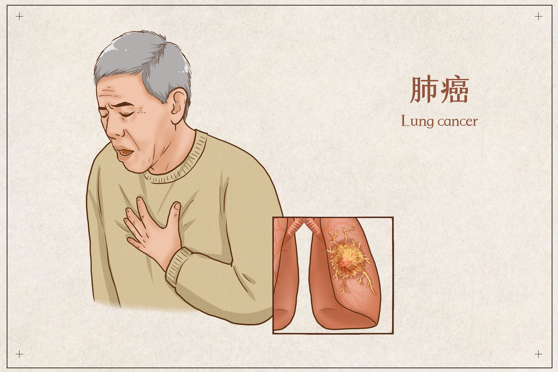 美国肺癌医院