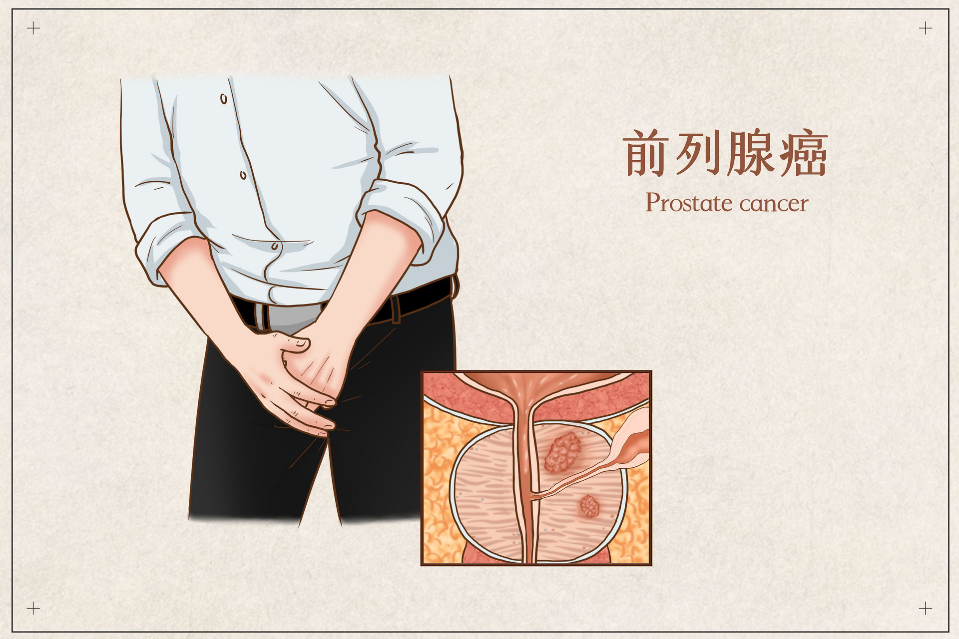 日本看病：日本治疗前列腺癌的优势