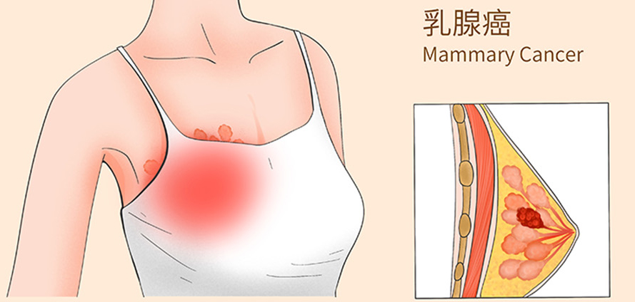 日本乳腺癌治疗优势及乳腺癌医院推荐