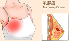 各类乳腺癌患者脑转移发生率分别是多少？美国新研究给出了答案！