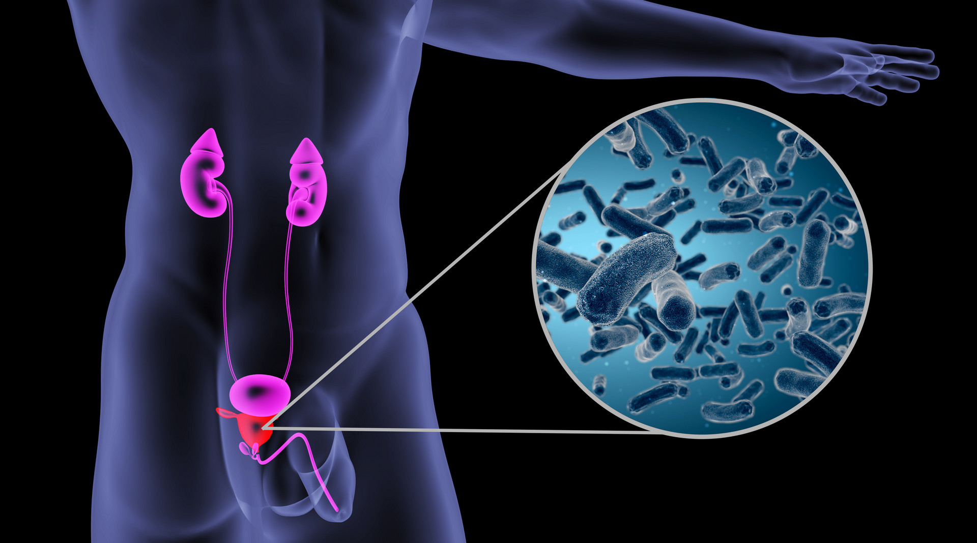 膀胱癌转移去美国治疗的优势有哪些？