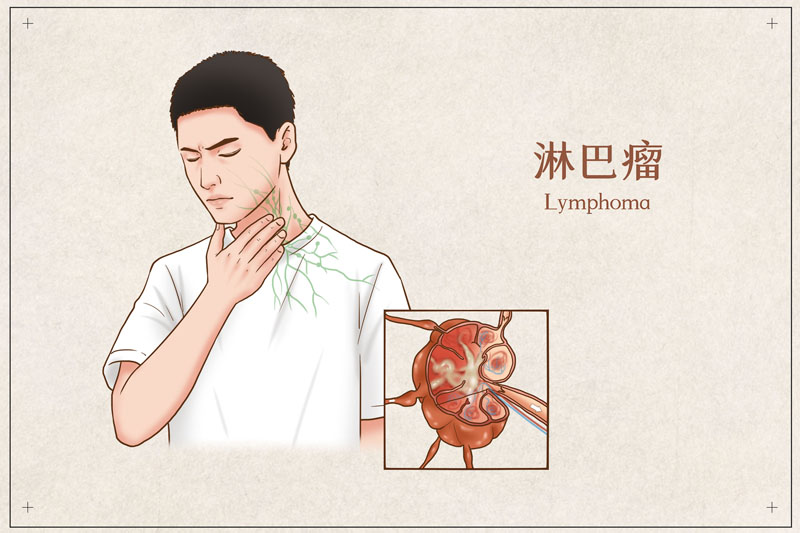 美国看病：淋巴瘤美国医院排名与治疗指南