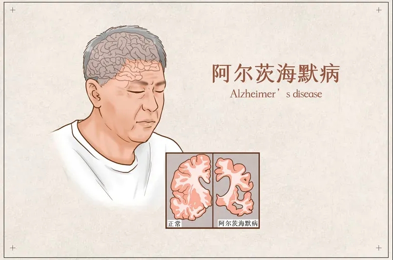 重磅！阿尔茨海默病口服新药ZUNVEYL在美国获批，疗效持久且副作用更低！