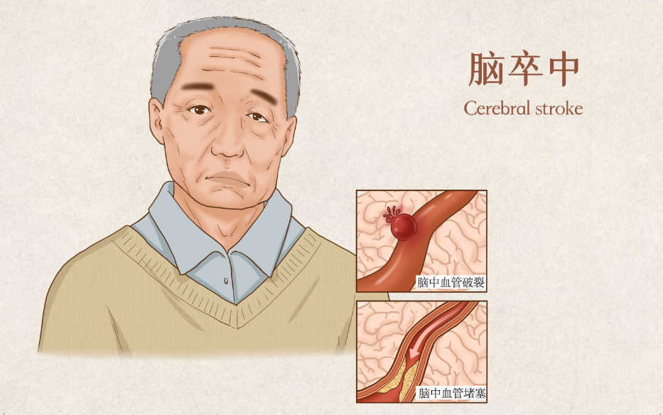 10月23日北京丨芝大医学教授:脑梗、脑溢血有哪些高危信号?如何不错过“黄金治疗机会”?(限时免费报名)