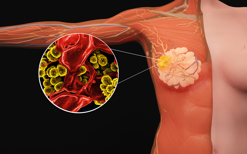 晚期乳腺癌患者一度靠轮椅生活，靠这家医院已成功抗癌8年！