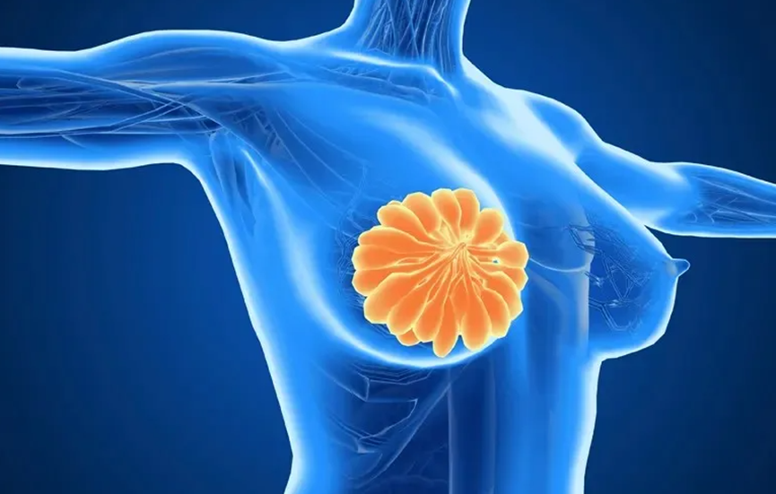 一次放疗就“清干净”乳腺癌？美国新研究给出惊喜答案！