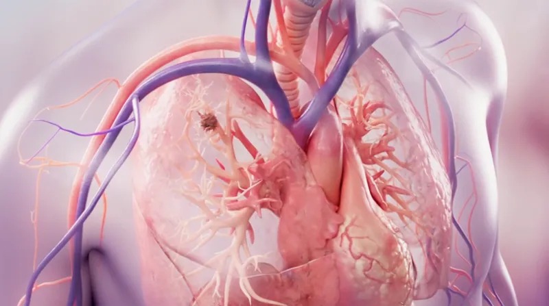 96%患者局部肿瘤被有效控制！Aliya脉冲电场消融技术对多种晚期实体瘤疗效显著