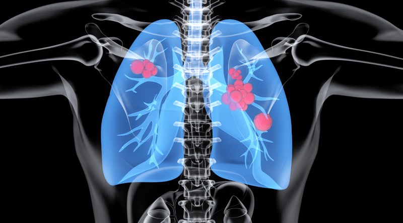 肺癌国外治疗转诊指南:优势解析与前沿药物盘点 肺癌国外治疗转诊指南:优势解析与前沿药物盘点