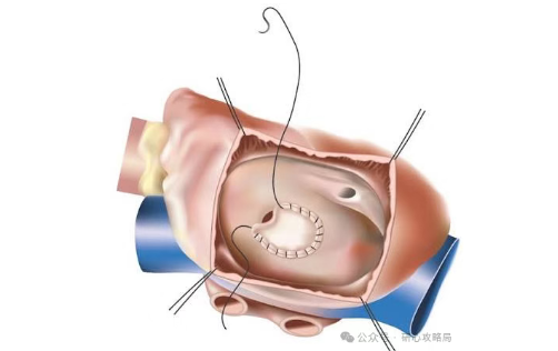 心脏上的“小洞”:房间隔缺损严重吗?什么时候该手术?