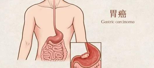 2025美国胃癌治疗新突破:4大前沿疗法与医院筛选指南 2025美国胃癌治疗新突破:4大前沿疗法与医院筛选指南