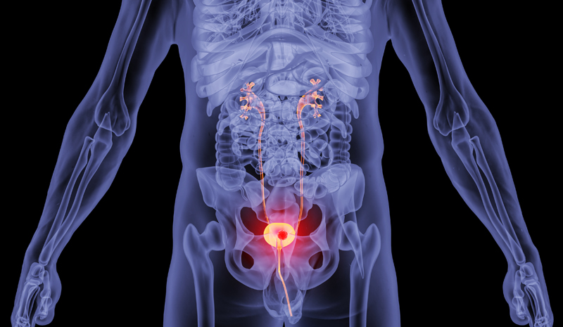 92%患者肿瘤完全消失!膀胱癌新药NDV-01带来突破性疗效