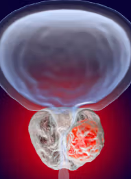 这类转移性癌症中，半数患者肿标下降超90%，四分之一患者血液中“癌细胞痕迹消失”！