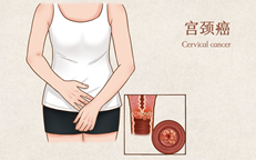 欧盟批准Tisotumab Vedotin，用于治疗复发或转移性宫颈癌