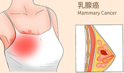 乳腺癌一线治疗耐药怎么办？Elacestrant联合靶向疗法带来新希望！
