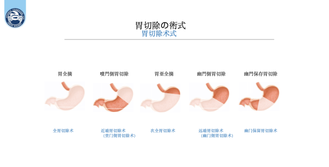 胃癌切除术