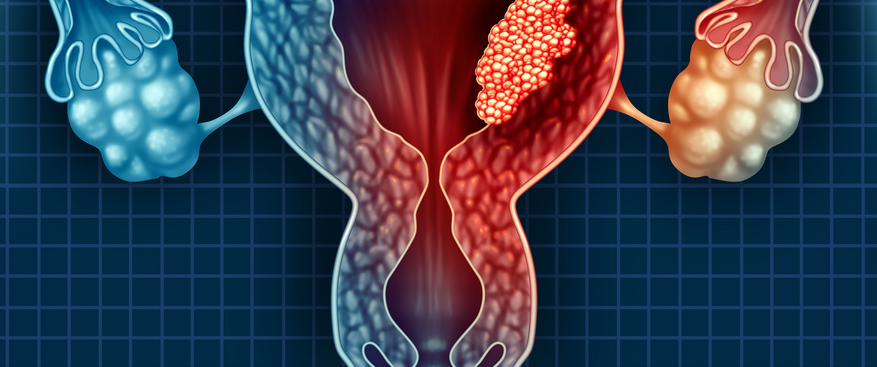 妇科癌症关注月：微创手术、免疫疗法的应用，正在改变子宫癌治疗格局！