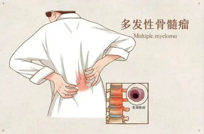 美国上市新药：疾病进展或死亡风险降低40%！多发性骨髓瘤新一线疗法在美获批