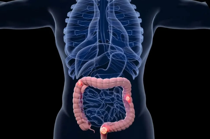 肠镜查出息肉，到底要不要切？盛诺一家健康顾问为您解答