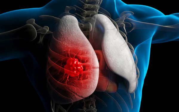 近3成鳞状非小细胞肺癌患者肿瘤缩小、超6成病情受控：美国FDA授予Gotistobart孤儿药资格
