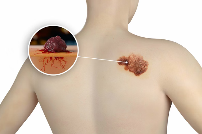 黑色素瘤新疗法：双药组合疗法康奈非尼(Encorafenib)＋比美替尼(Binimetinib)有效控制疾病进展