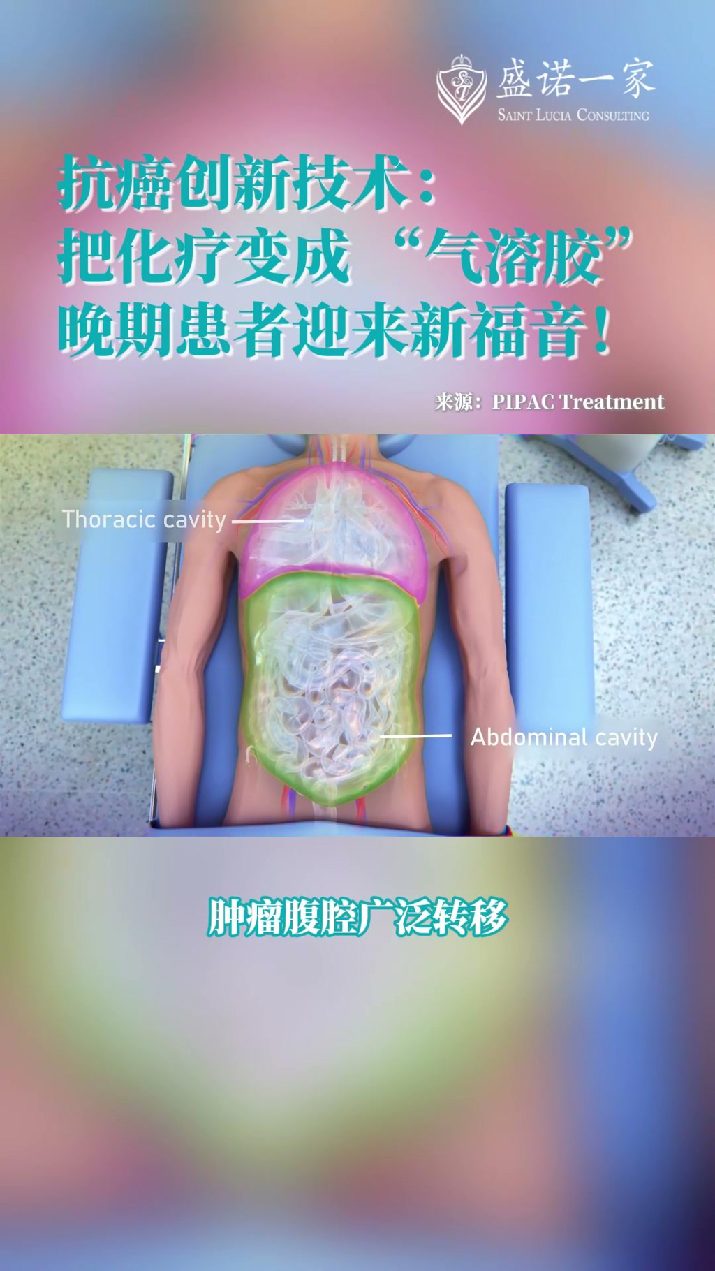 针对腹腔广泛转移肿瘤的新技术PIPAC，只需全程微创手术