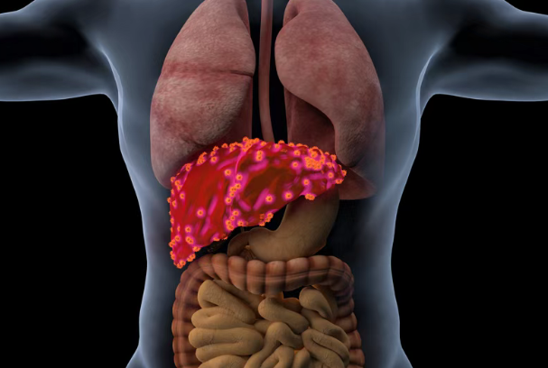 肝癌治疗新动向：美国新药PLT012获快速通道资格，开辟肝癌免疫治疗新路径