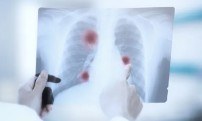 美国就医案例：10公分肿瘤紧贴心脏，医生说“可能下不了手术台”…他在美国梅奥诊所完成治愈之路！