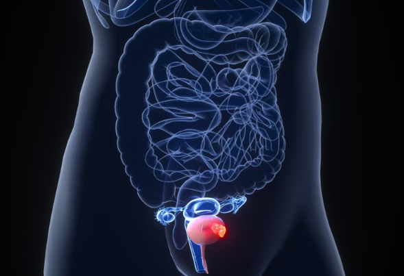 “保膀胱”新疗法动力疗法TLD-1433，使64.4%患者肿瘤完全消失，最长7年未复发！