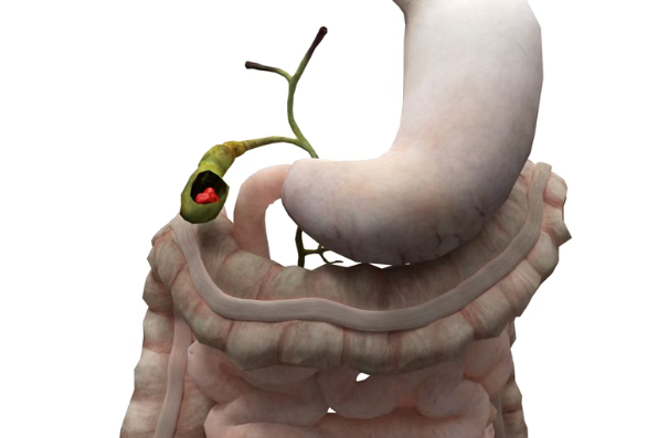 美国新药前沿：FDA授予Zenocutuzumab孤儿药资格，为罕见胆管癌患者带来新希望！