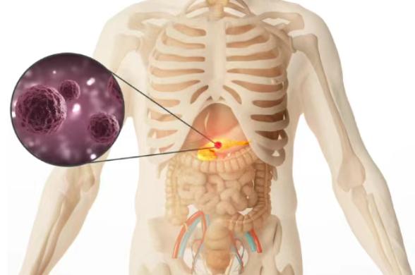 美国妙佑医疗国际(原梅奥诊所)1400例研究颠覆指南:这类胰腺癌,明确应“先化疗再手术”!