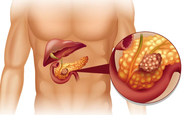 重磅！胰腺癌检出率高达91.9%，美国科学家找到胰腺癌筛查新方法