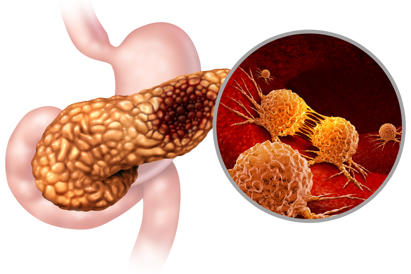美国上市新药：76%患者病情得到控制！胰腺癌新药NP-G2-044获孤儿药资格