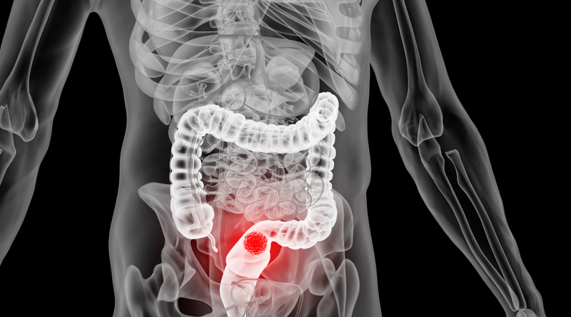 美国新药联合方案让RAS突变结直肠癌迎来突破，72.2%患者肿瘤明显缩小或消失！