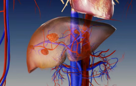 92%肝癌患者肿瘤完全消失！SIR-Spheres Y-90疗法带来“震撼”数据