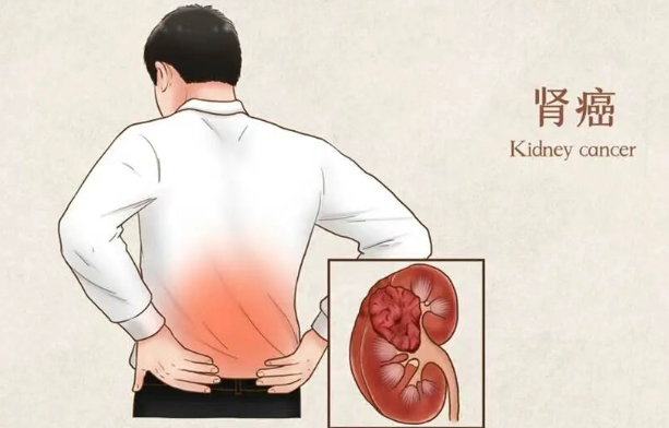 全球首个！美国肾癌新药联合方案：超50%患者肿瘤缩小，攻克免疫耐药！